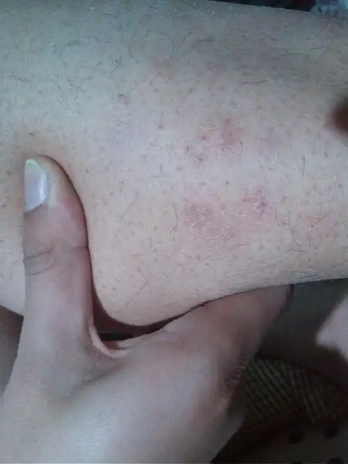 我男朋友小腿外侧长了这个东西,是癣呢还是