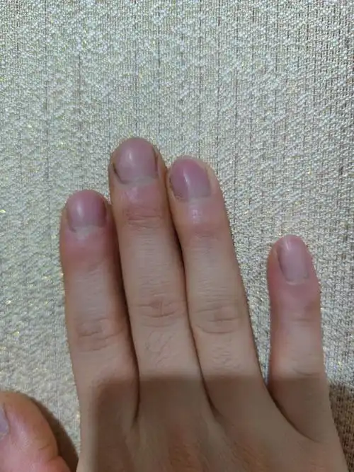 能帮我看看是杵状指吗,突起那里每天都是红的,指甲也是往下的,去医院