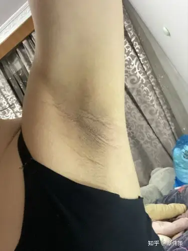 剃掉腋毛是否会减轻狐臭呢?夏天到了好尴尬? - 知乎