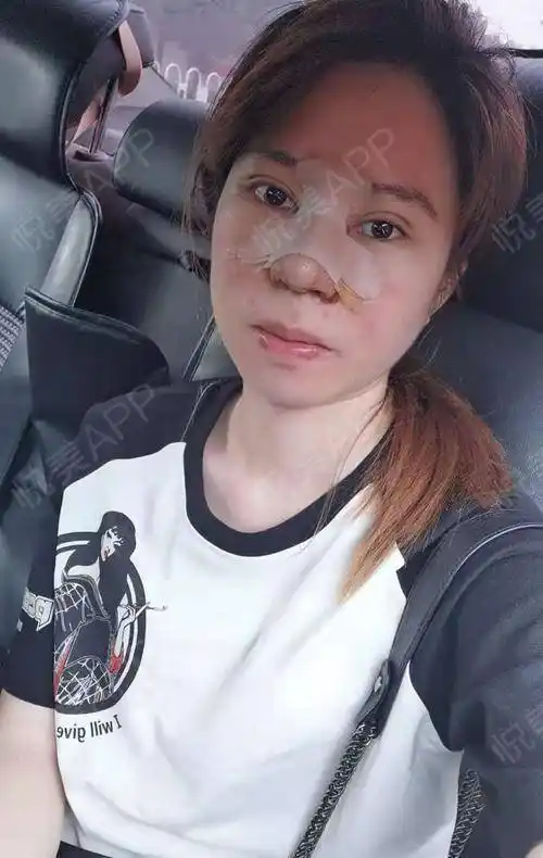 没有拍多少恢复期的照片,大家随意看看吧.第一张照片.