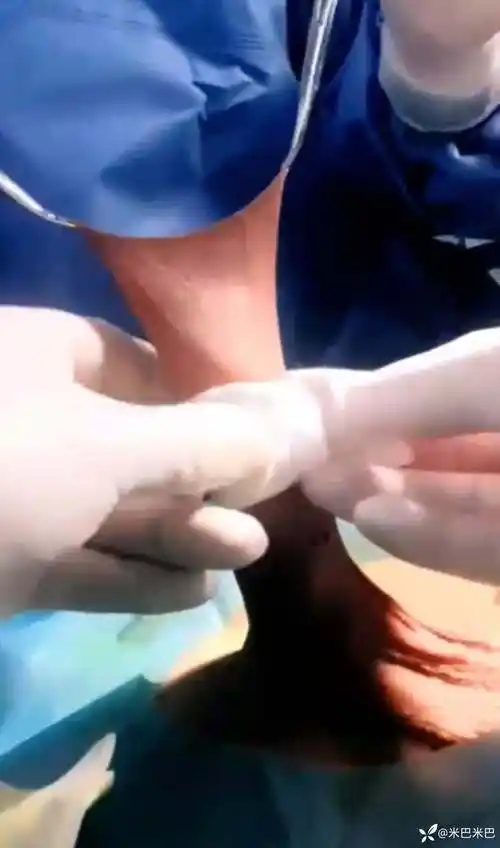 包皮较长者非手术暴露龟头方法参考