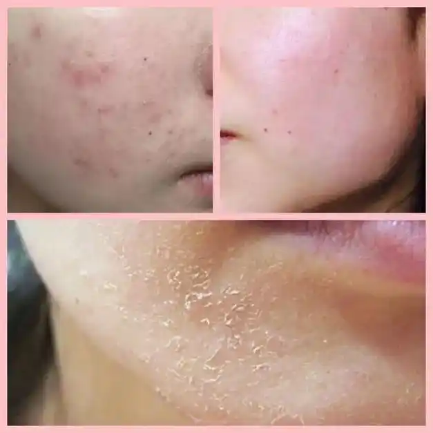 皮肤屏障受损出现的症状!屏障受损的表现 1.初期症状:皮肤紧 - 抖音