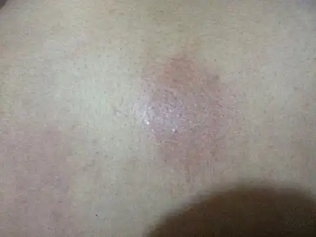 后背皮肤变这样了 有些痛 感觉还在冒水 不多 像