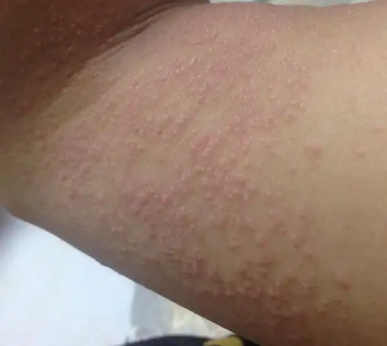 过敏性湿疹皮炎图片_有来医生