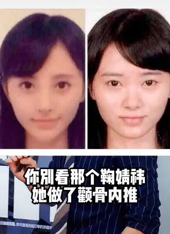 然而,观察鞠婧祎近几年的照片可以明显发现她原本外扩的颧骨和颧弓很