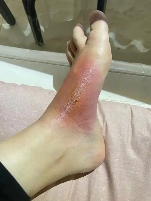 记录孕妇脚面开水烫伤恢复过程