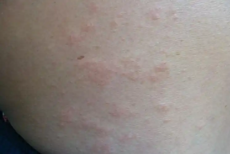 夏季皮炎图片_夏季皮炎症状表现图片大全_有来医生