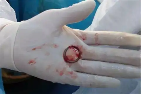 女性取环手术是一种什么体验