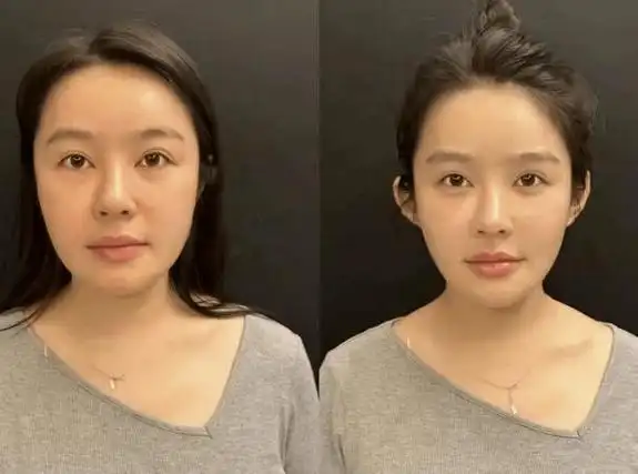 外轮廓是指,从发际线沿着面部外侧,一直到下巴,整个的u型 v型轮廓,也