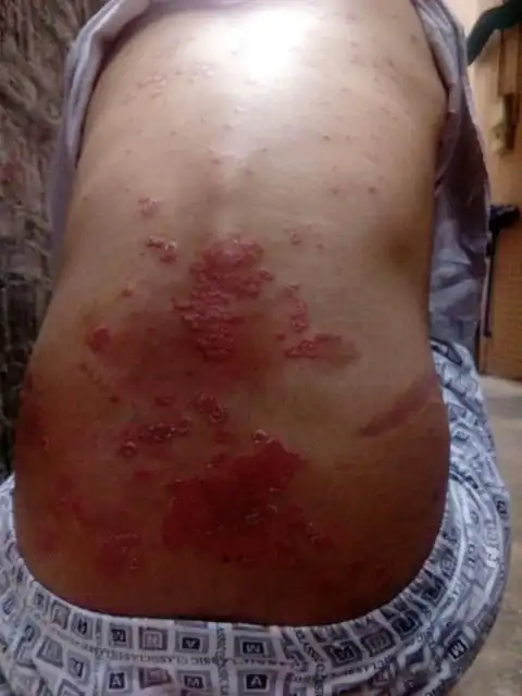 小儿头部牛皮癣图片