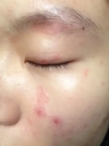 脸部无故起了红片皮肤变得粗糙红的地方会痒以前两鬓额头并没有过过敏