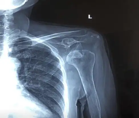 【康复小课堂】偏瘫后肩关节半脱位的康复预防及治疗