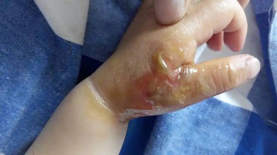 前天手不小心被开水烫伤了!当时就起了泡!