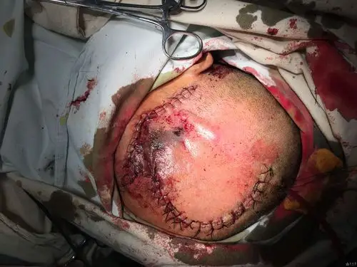 颅脑损伤分享一例严重头皮撕脱伤病例原创