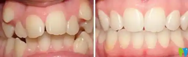 属于中山禾佳虎牙矫正案例前后对比图