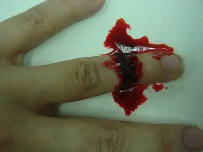 梦见从胳膊抽血献血抽血后胳膊淤青还发紫2022已更新今日图集