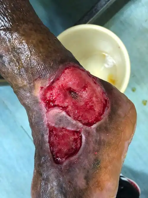 下肢静脉曲张伴溃疡,三阶段疗法走起!