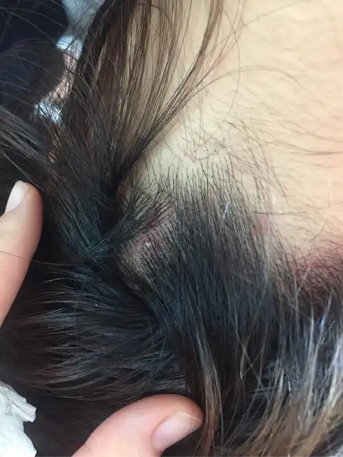 头皮上脂溢性皮炎和毛囊炎共生,多年,你们有根治的么?一起交流一下吧?