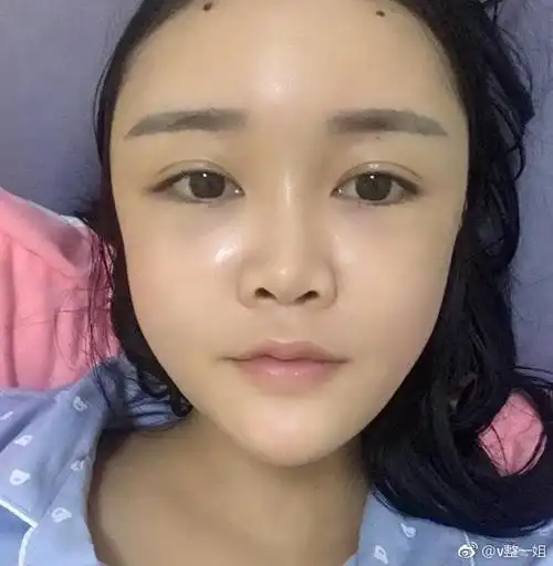 成都自体脂肪填充全脸案例分享,术后恢复两个多月效果.