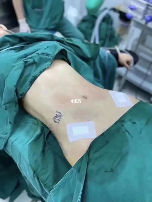 腰腹环吸手术室原图对比90 吸脂是目前瘦身最有效的方法,效果立竿见