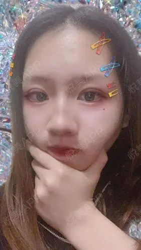 全切双眼皮术后43天_双眼皮术后43天_眼部整形术后43天_整个江湖都任