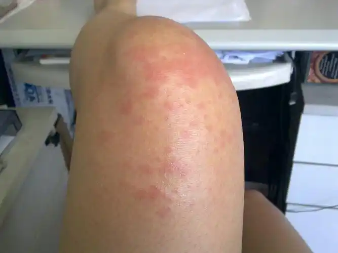 主题:腿上发了很多红点,有点痒,是过敏吗?