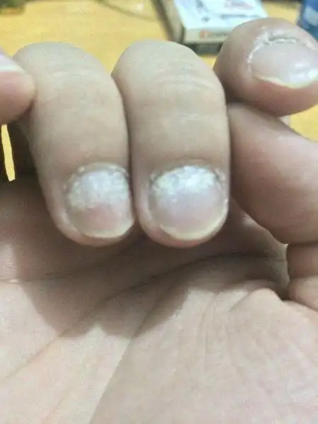 手指甲上有很多白色的斑点,求病因