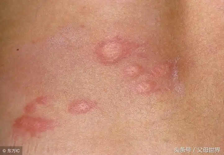 这些红疹可不是蚊子包,妈妈们一定不能大意!