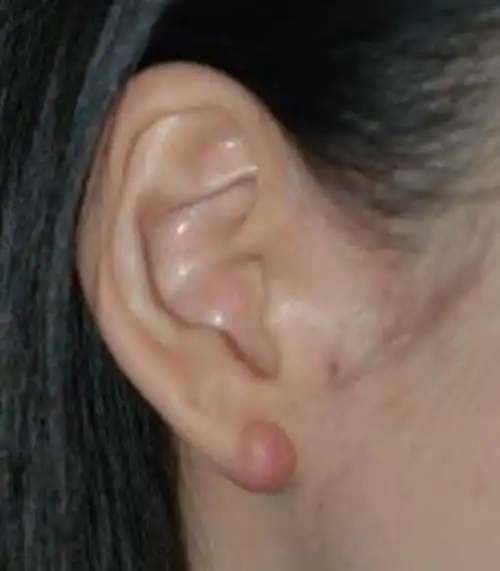 女性耳部淋巴癌中度患者图片