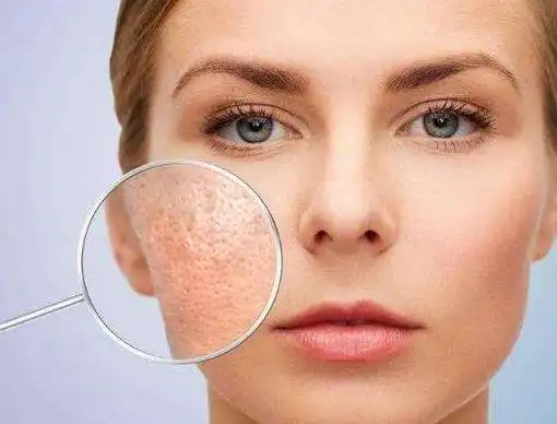 皮肤毛孔粗大很难看,女生该怎么护理和改善,皮肤专家教你怎么做
