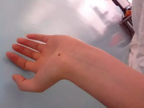 获得性太田痣图片