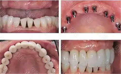 半口牙缺失的治疗方法揭秘:种植牙or半口牙齿修复哪种适合