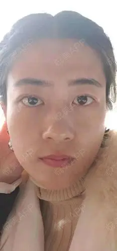 上睑下垂矫正术后30天_眼型矫正术后30天_眼部整形术后30天_悦mer