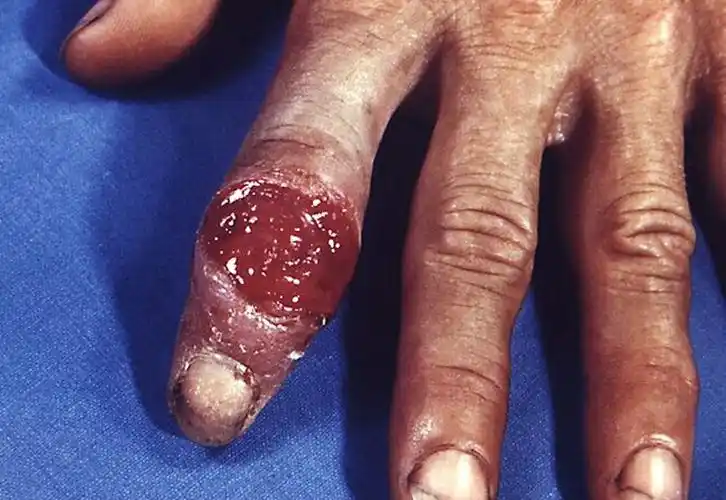 早期梅毒感染症状图图片