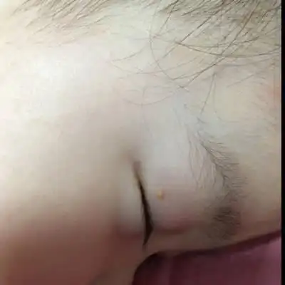 宝宝眼皮上长了一个小颗粒状的东西,有宝妈知道是什麼吗?