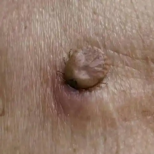 吓人永康一男子以为是长了颗痣原来竟是