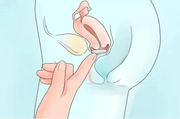 靠这两个方法,帮"出走的子宫"回家,妥了!_患者_手术_阴道