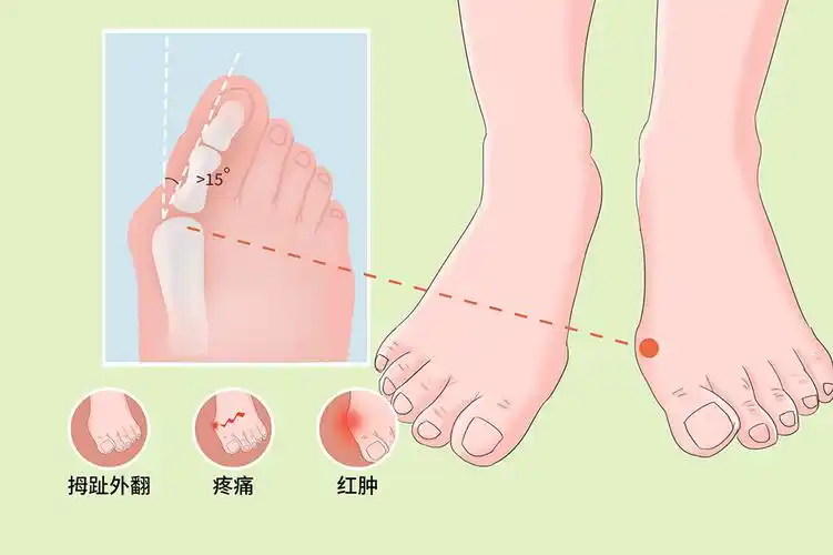 拇囊炎,胼胝,骨性关节炎治疗周期:短期治疗临床症状:拇趾外翻,疼痛