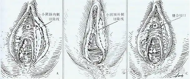 问题解答小阴唇肥大整形手术有必要吗