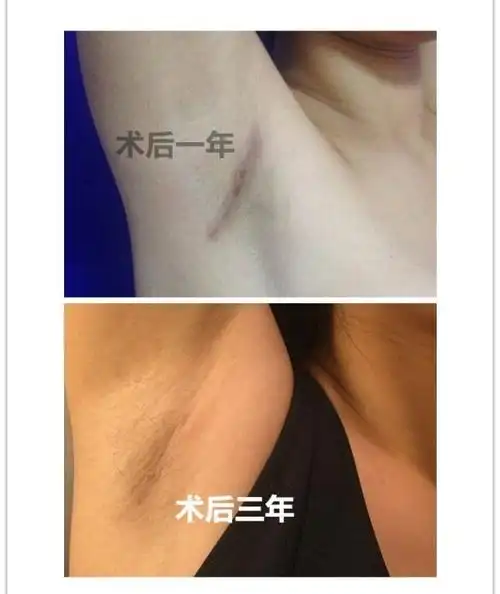 腋下切口隆胸恢复图片