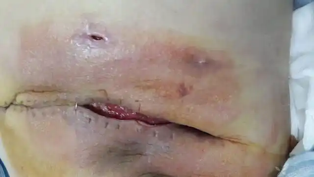 患者乳癌术后12天环⒏呷,后证实是伤口感染,给予抗炎换药处理后全身