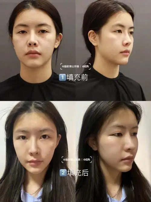 自体脂肪面部填充一定会肿吗什么时候消肿