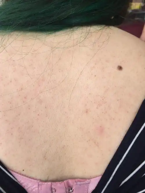 他们说我的后背都是黑色的毛,然后红红的,从高中开始,有图,帮我看