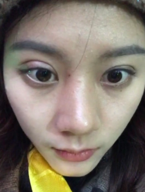 双眼皮失败修复|两侧不对称|宽修窄 填脂肪