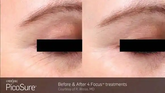 眼周细纹治疗前后对比图