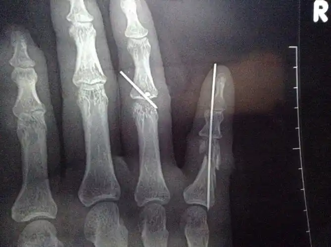 克氏针过两天就可以拔了,然后到公司私了大概能赔