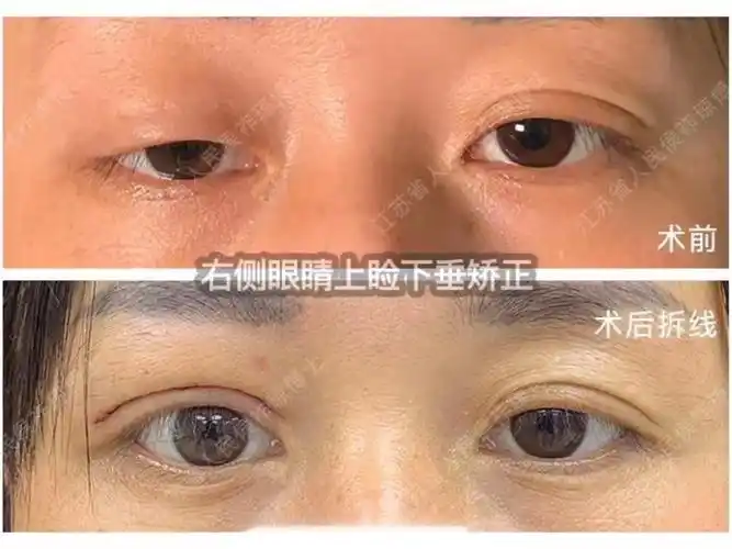 右侧重睑修复右侧上睑下垂矫正术后7天