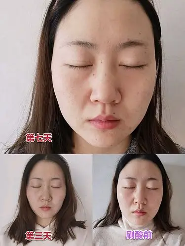 我是上周做的果酸焕肤,现在给大家聊聊恢复的过程和效果