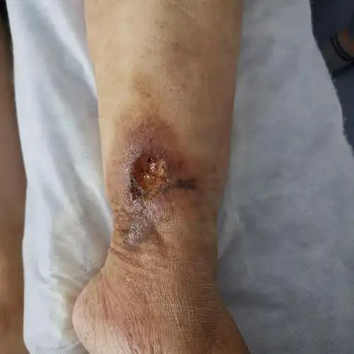 老烂腿—下肢大隐静脉曲张合并静脉性溃疡,介入微创疗效好.