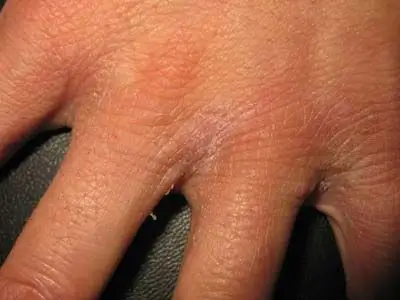 疥疮的早期症状有哪些_疥疮_北京京城皮肤病医院(北京医保定点机构)